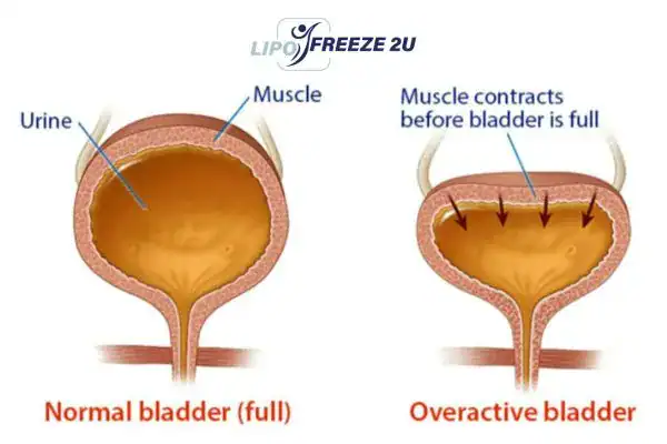 diagram of overactive bladder treatment Spalding