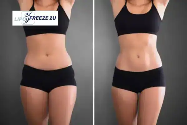 How Can LIPO FREEZE 2U Support Your Post-Pregnancy Body Recovery Spalding?