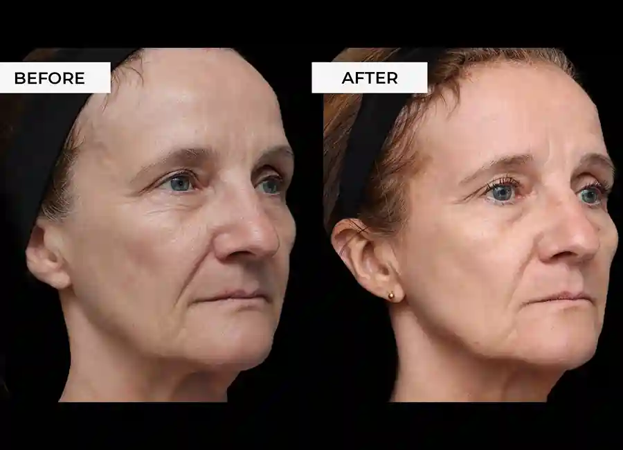 How Many RF Microneedling Sessions Will You Need to See a Difference Spalding?