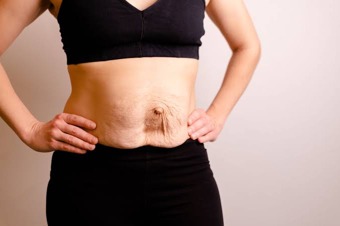 Is Surgery Really the Only Way to Repair Diastasis Recti Spalding?