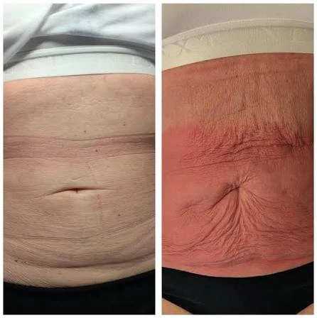How Does RF Microneedling Improve Crepey, Thin and Uneven Skin Texture Spalding?