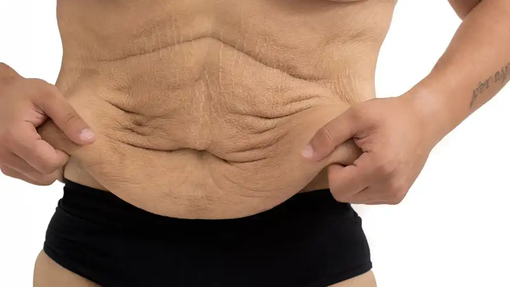 Why Does Weight Loss Medication Leave Some People With Loose or Sagging Skin Spalding?